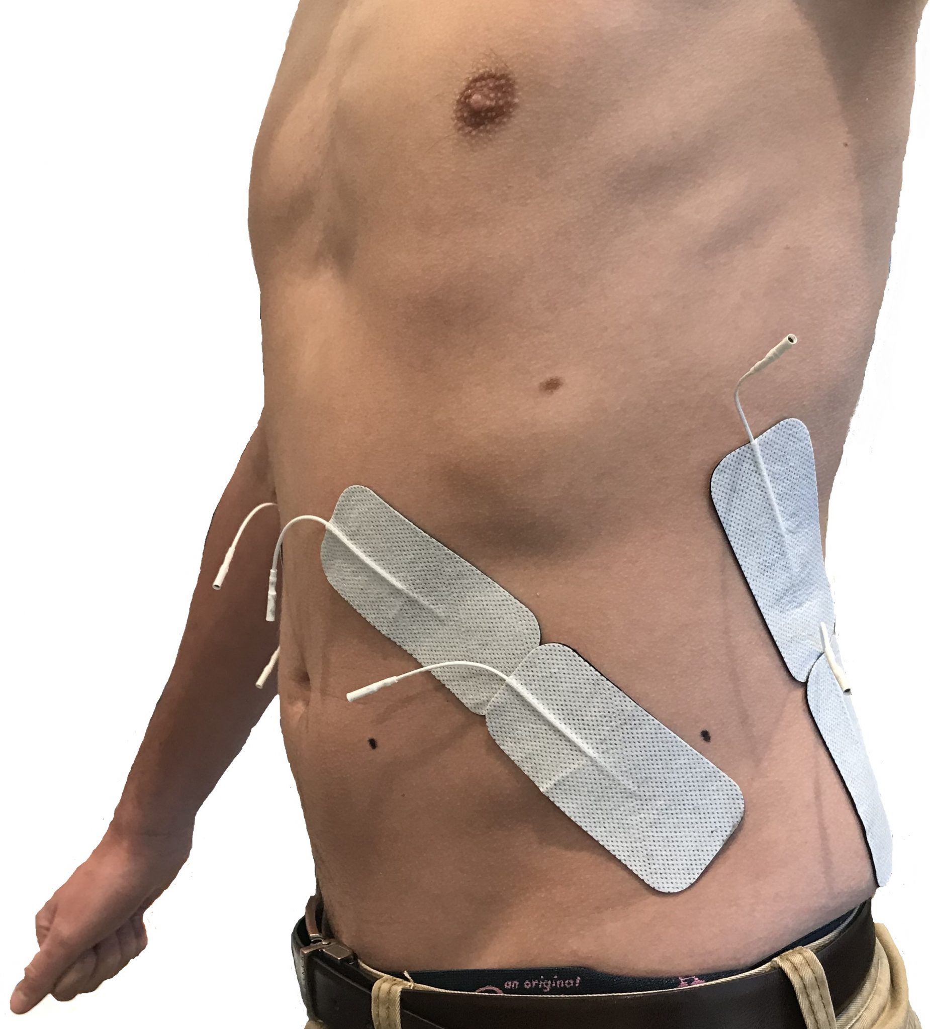 Front view of patient's abdominal taping (rectus abdominus and